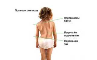 Какие физические упражнения полезны при сколиозе?