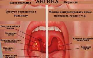 Как лечить ангину народными средствами?