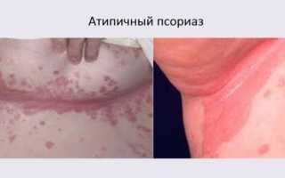 Атипичный псориаз: симптомы и лечение
