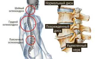 Лечение остеохондроза шейного отдела