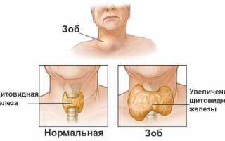 Лечение зоба щитовидной железы