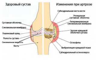 Основные симптомы артроза коленного сустава и методы его лечения