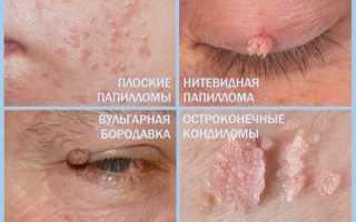 Избавление от папиллом в домашних условиях