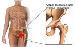 Методы лечения коксартроза тазобедренного сустава