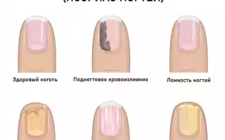 Лечение псориаза на ногтях