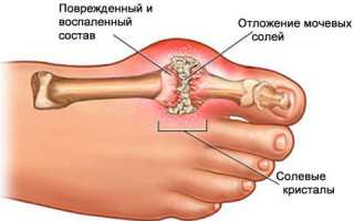 Минеральная вода: польза при подагре