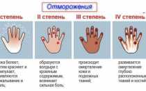 Симптомы и способы лечения при обморожении рук и пальцев