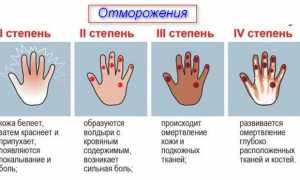 Симптомы и способы лечения при обморожении рук и пальцев