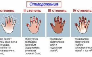 Симптомы и способы лечения при обморожении рук и пальцев