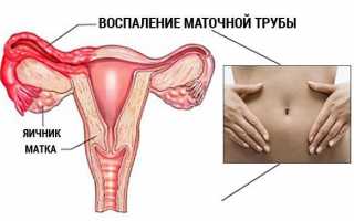Лечение воспаления придатков у женщин