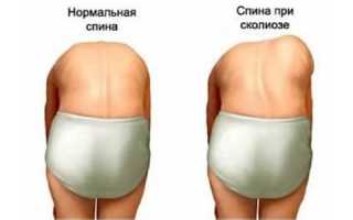 Эффективное лечение сколиоза