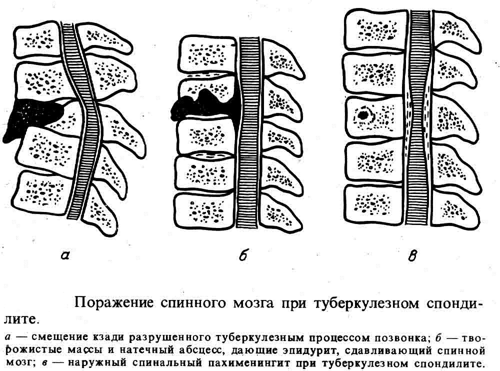Поражение спинного мозга при туберкулезном спондилите