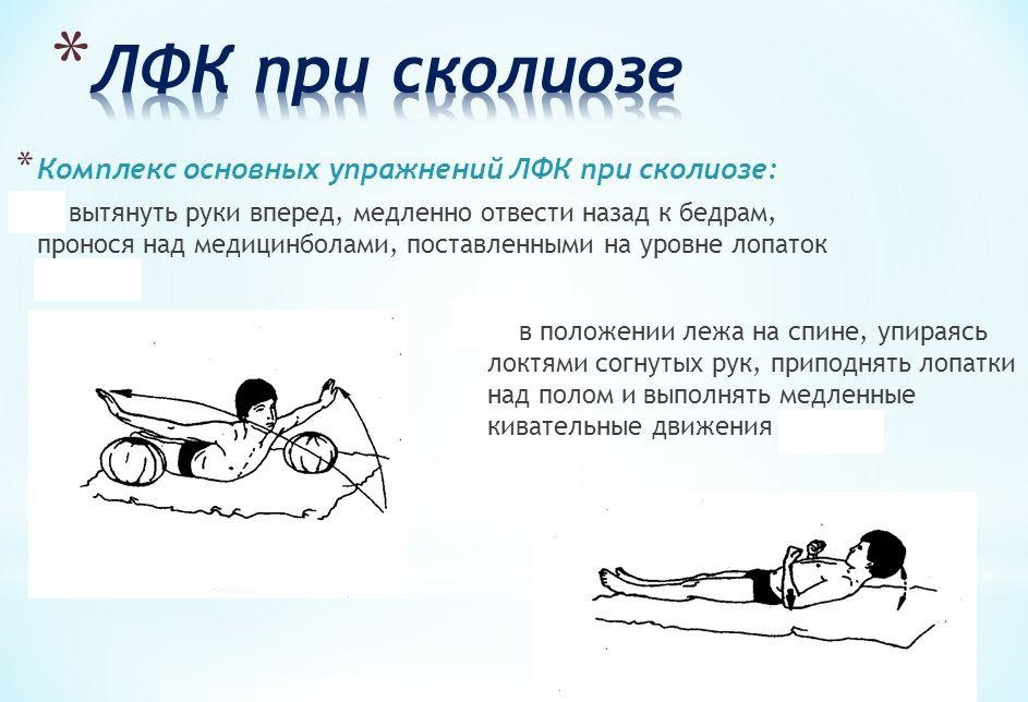 Комплекс основных упражнений ЛФК при сколиозе
