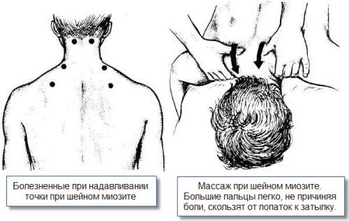 Массаж при миозите