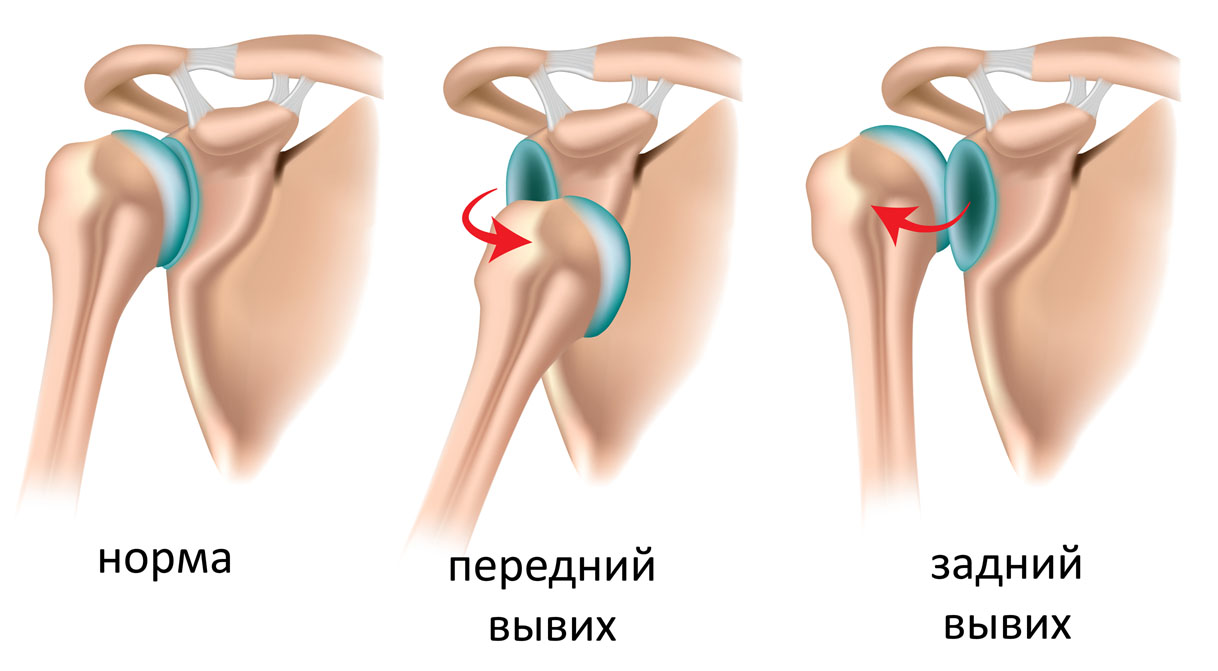 Варианты вывиха плеча