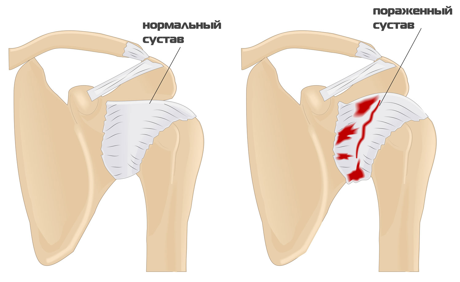 Плечелопаточный периартрит