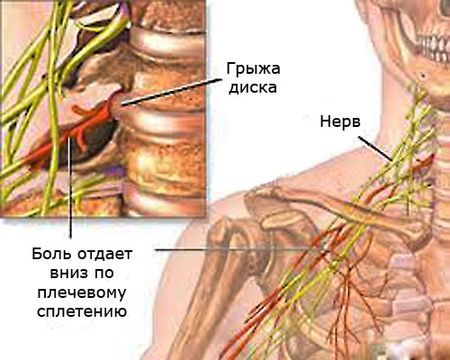 Признаки шейного остеохондроза