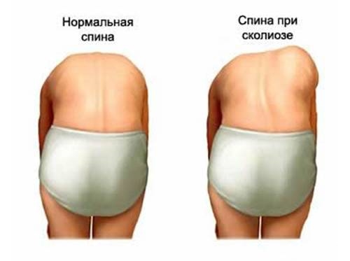 Визуальная диагностика сколиоза