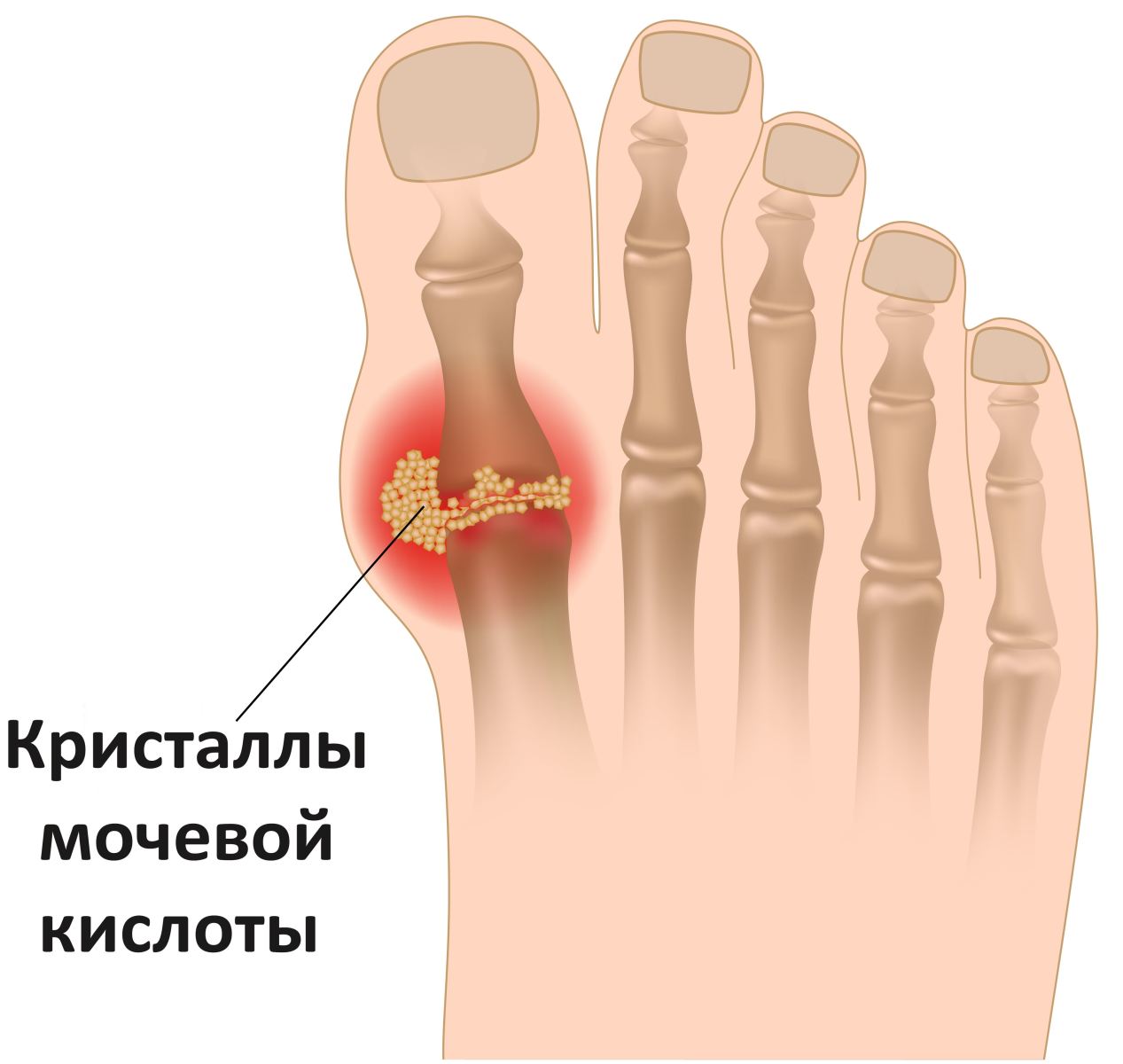 Скопление кристаллов мочевиной кислоты при подагре