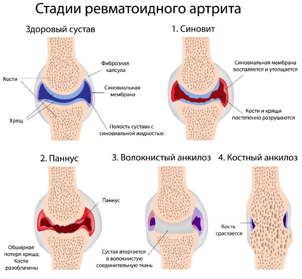 Стадии артрита
