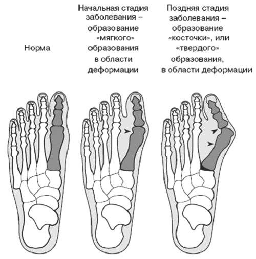 Стадии бурсита стопы