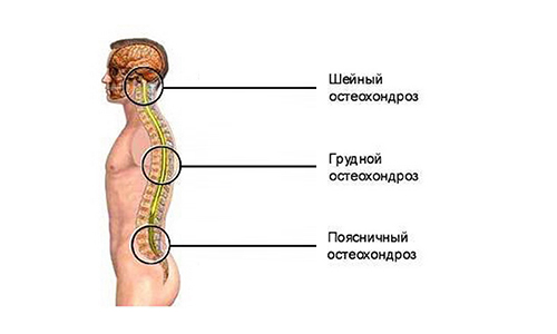 Виды остеохондроза