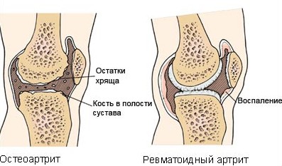 Остеоартрит и ревматоидный артрит
