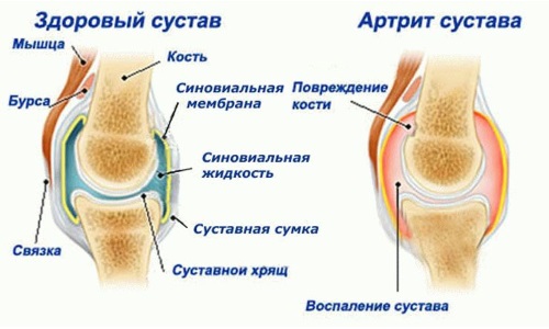 Изменения в суставе при артрите