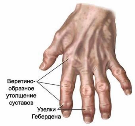 Последняя стадия полиартрита
