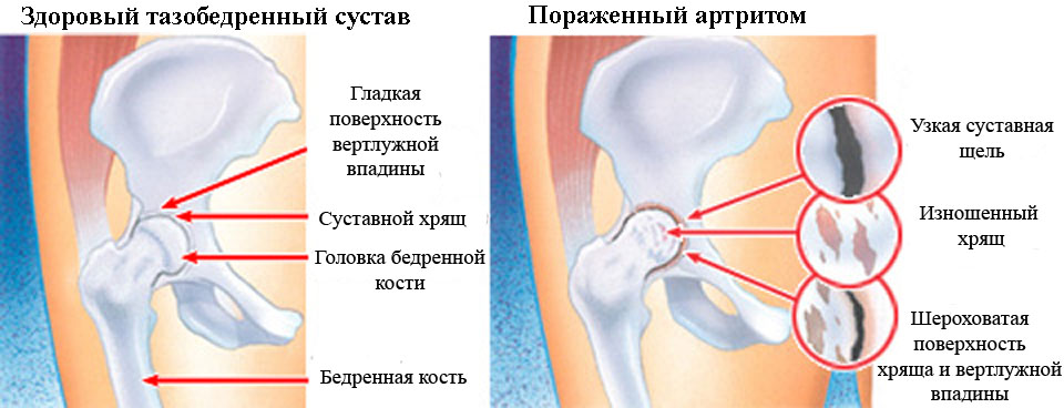 Здоровый и пораженный артритом тазобедренный сустав