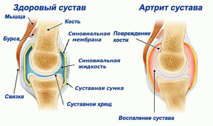 Схема артрита коленного сустава