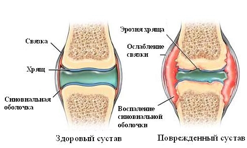 Схема артрита