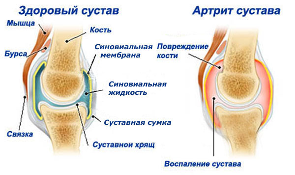 Схема артрита
