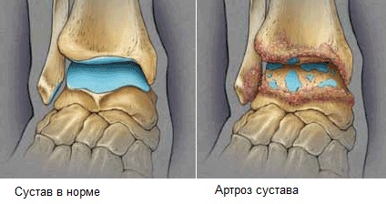 Нормальный сустав и сустав с артрозом