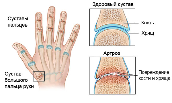 Схема артроза пальцев рук