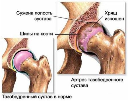 Артроз тазобедренного сустава
