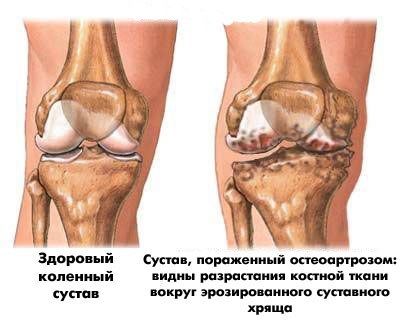 Схема деформирующего артроза