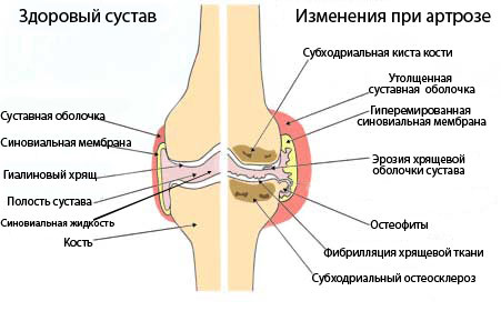 Здоровый коленный сустав и пораженный артрозом