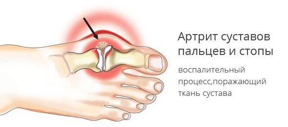 Схема артрита стопы