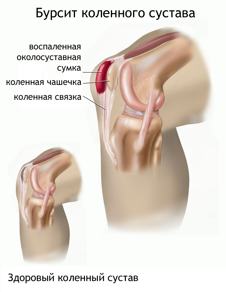 Схема бурсита колена