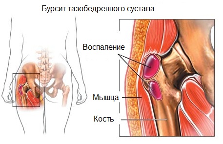 Тазобедренный сустав, пораженный бурситом