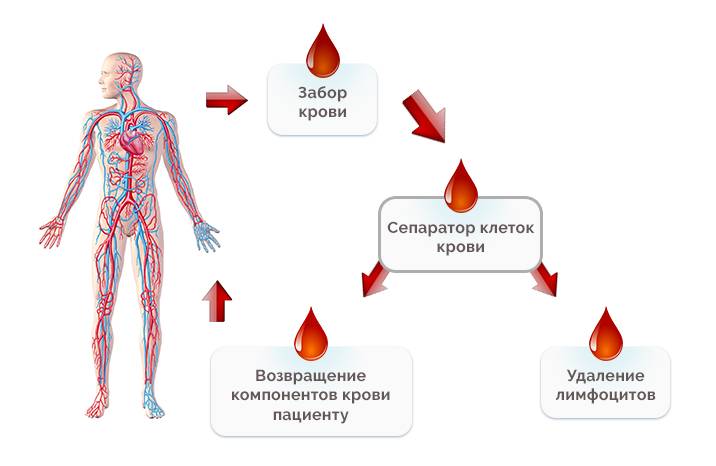 Лимфоцитаферез при лечении ревматоидного артрита