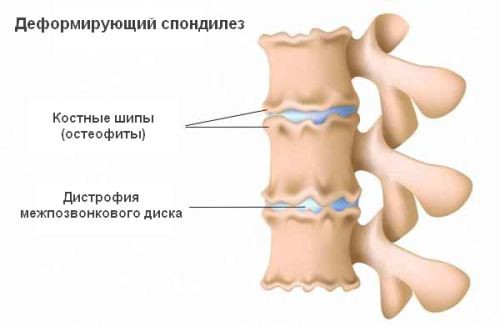 Деформирующий спондилез