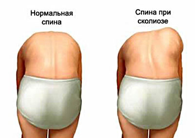 Визуальная диагностика сколиоза