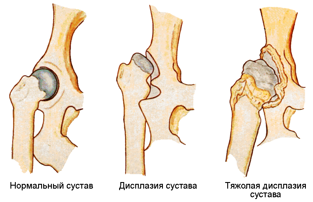 Схема дисплазии тазобедренных суставов у детей