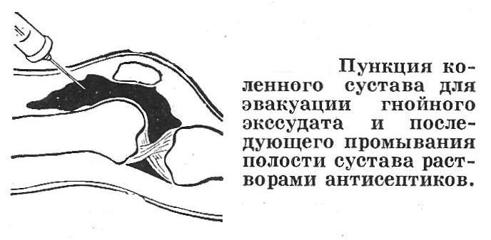 Лечение гнойного бурсита колена