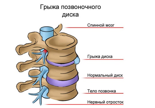 Схема межпозвоночной грыжи позвоночника