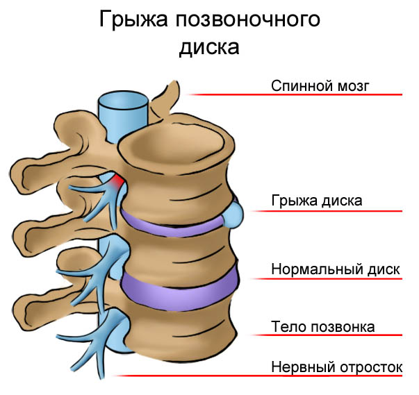 Схема межпозвоночной грыжи