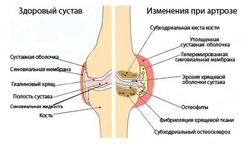 Изменения в суставе при артрозе