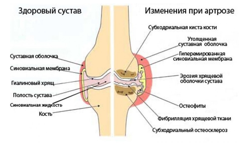 Изменения при артрозе